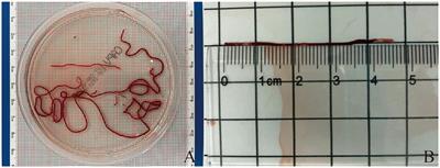 Comparing needle types and aspiration techniques in EUS-TA to optimize diagnostic efficacy and specimen quality in patients with pancreatic lesions